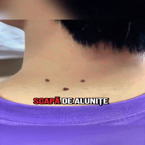 Plasturi pentru papiloame si negi